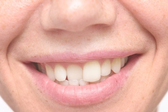 Crooked Teeth in Amherst, New York